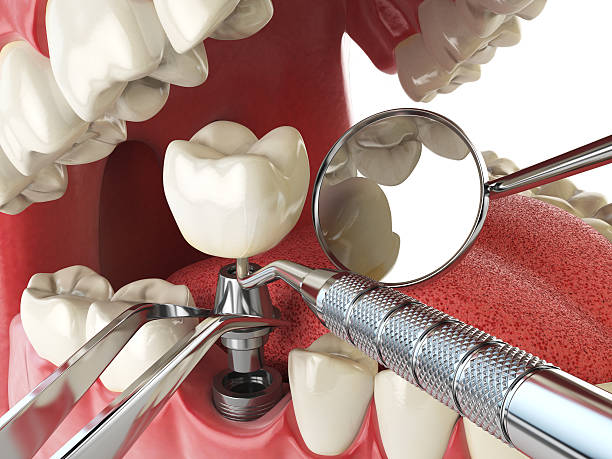 Best Knocked-Out Tooth Emergency  in Sibley, LA